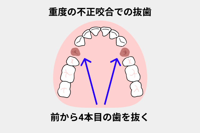 重度の不正咬合での抜歯