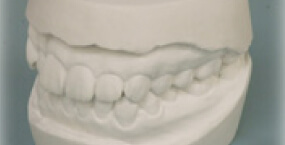 歯型・精密模型